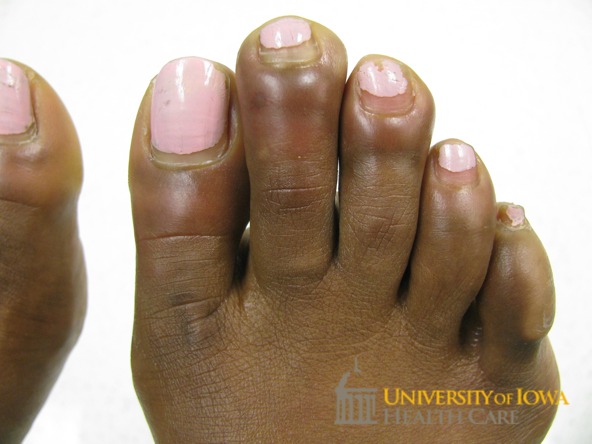 Erythema and edema of the toes. (click images for higher resolution).